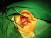 mastoid cavityA