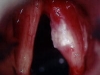 leukoplakis-vocal-cord