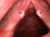 singers-nodule_0