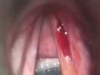 vocal-abuse