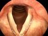 vocal-nodule