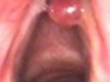 vocal-nodule2_0
