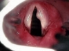 vocal-nodule3_0