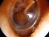 glue-ear