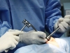 septoplasty2
