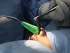 splint1