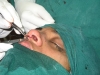 rhinoplasty10