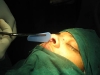 rhinoplasty12