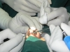 rhinoplasty2