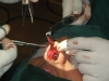 rhinoplasty2b
