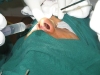 rhinoplasty3
