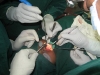 rhinoplasty5