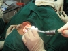 rhinoplasty7