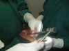 rhinoplasty8
