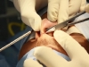 11-rhinoplasty2