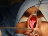 12-rhinoplasty-procedure5
