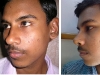 preop-and-post-op4