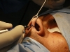 rhinoplasty-procedure3