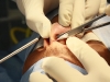 rhinoplasty-procedure4