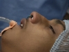 nasal-packing