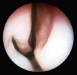 turbinate-after-vasoconstriction