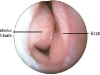 turbinate