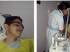 facial-mole-removal-by-laser2