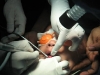 laser-release-tongue-tie