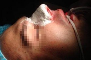 rhinoplasty2