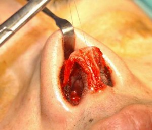 rhinoplasty3
