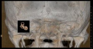 3D CT inner ear1