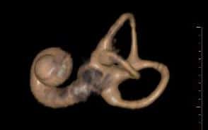 3D Ct inner 4