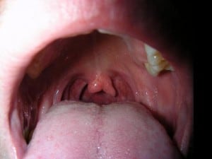 Bifid uvula