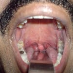 Blue uvula Blue uvula