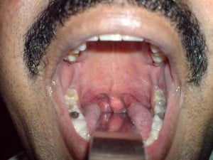 Blue uvula