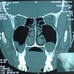 CT Sinuses7