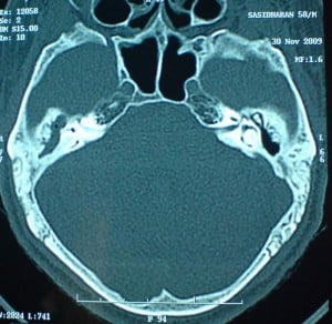CT brain CT brain