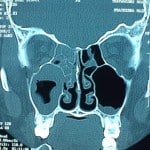 CT sinusitis2 CT sinusitis2