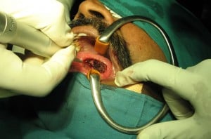 Ca tongue laser