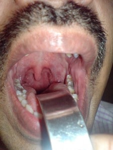 Throat infection