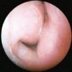 allergic turbinates