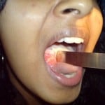 apthous ulcer1
