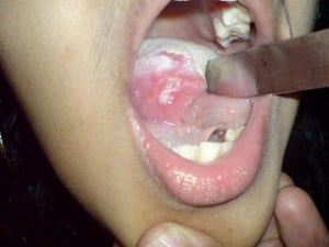 apthous ulcer2