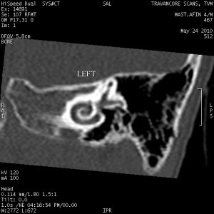 atresia left ear 2