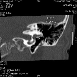 atresia left ear1