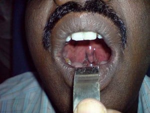 blue uvula