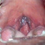 blue uvula 3 blue uvula 3