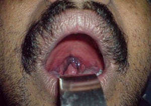 blue uvula1