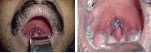 blue uvula1