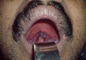 blue uvula1